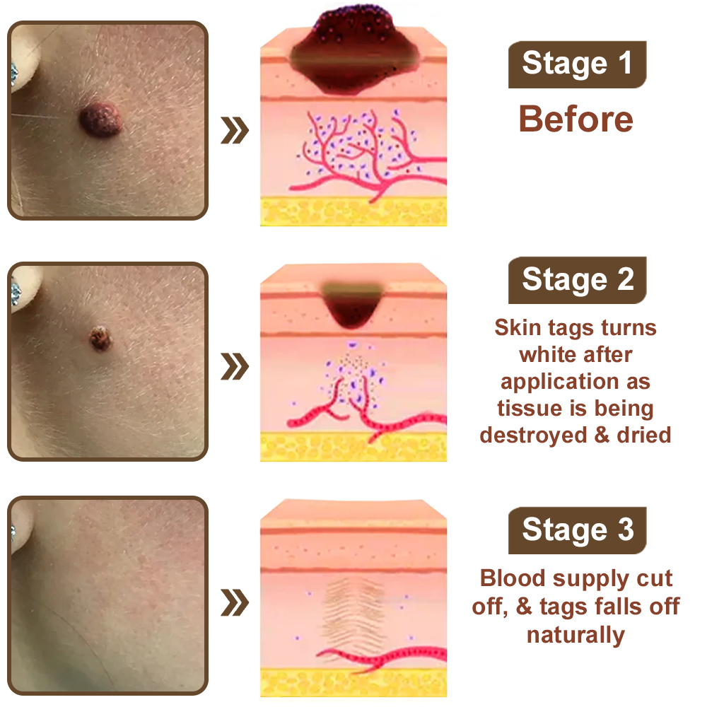 ✨ Zvoevo® Rice Bran Extract Cream 👩⚕️ TGA-Certified (For removing warts and skin growths, eliminating skin hyperplasia and keratin buildup, treating skin cancer, age spots, and hyperpigmentation)