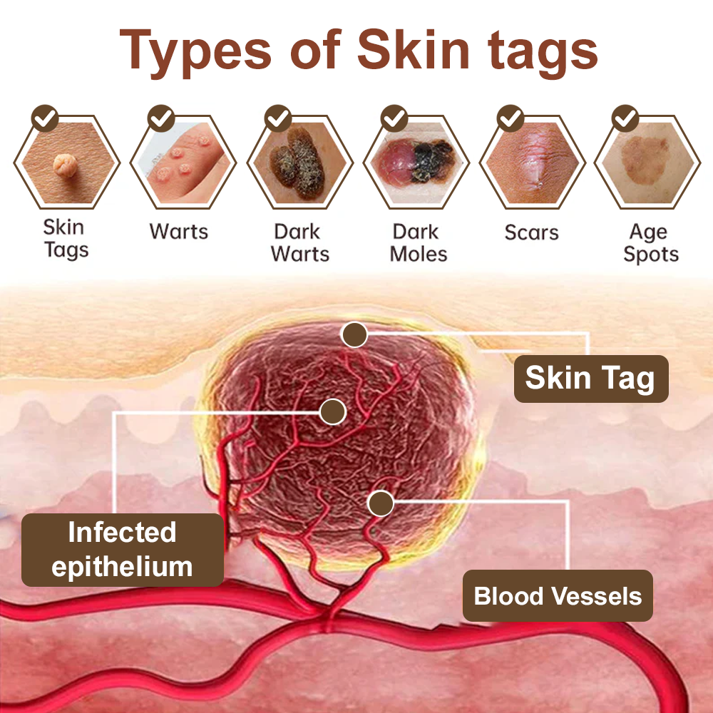 ✨ Zvoevo® Rice Bran Extract Cream 👩⚕️ TGA-Certified (For removing warts and skin growths, eliminating skin hyperplasia and keratin buildup, treating skin cancer, age spots, and hyperpigmentation)