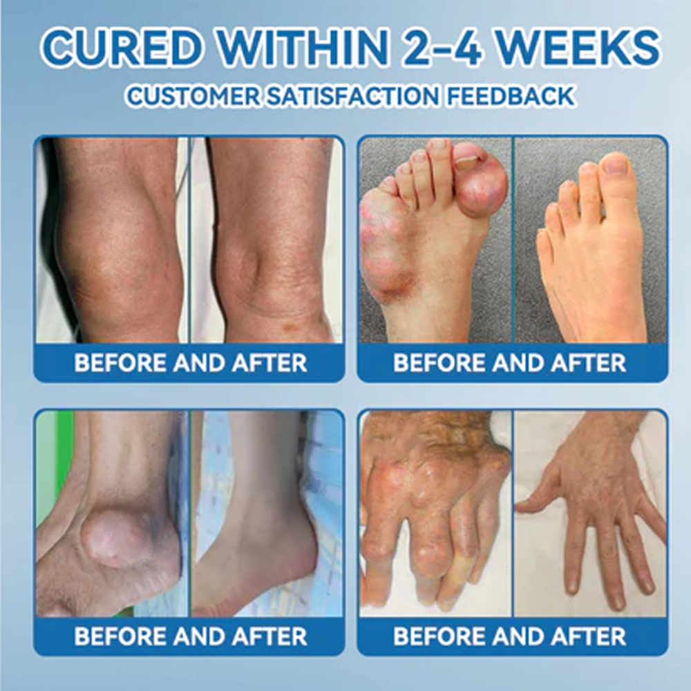 โ
๐๐ฏ๐จ๐๐ฏ๐จยฎ ๐ฉ๐๐-๐๐๐ Joint Cream (๐ฆ๐บ Relief for Arthritis, Neuropathy, Sports Injuries & Rheumatism)