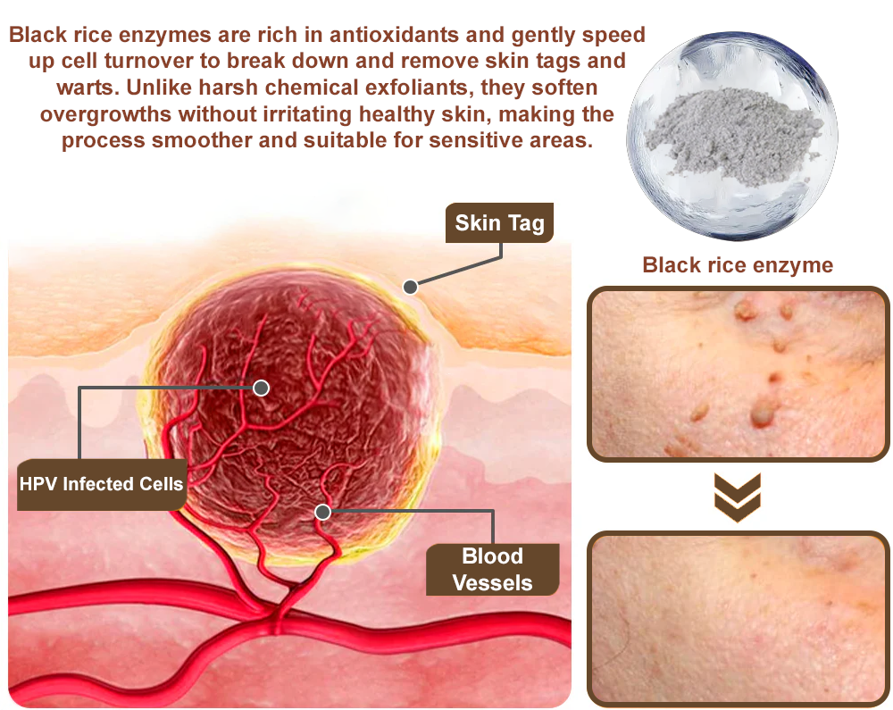 ✨ Zvoevo® Rice Bran Extract Cream 👩‍⚕️ TGA-Certified (For removing warts and skin growths, eliminating skin hyperplasia and keratin buildup, treating skin cancer, age spots, and hyperpigmentation)