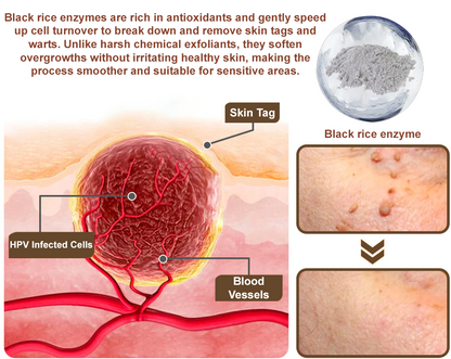 ✨ Zvoevo® Rice Bran Extract Cream 👩‍⚕️ TGA-Certified (For removing warts and skin growths, eliminating skin hyperplasia and keratin buildup, treating skin cancer, age spots, and hyperpigmentation)