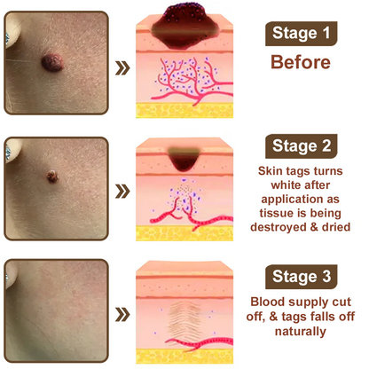 ✨ Zvoevo® Rice Bran Extract Cream 👩‍⚕️ TGA-Certified (For removing warts and skin growths, eliminating skin hyperplasia and keratin buildup, treating skin cancer, age spots, and hyperpigmentation)