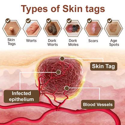 ✨ Zvoevo® Rice Bran Extract Cream 👩‍⚕️ TGA-Certified (For removing warts and skin growths, eliminating skin hyperplasia and keratin buildup, treating skin cancer, age spots, and hyperpigmentation)